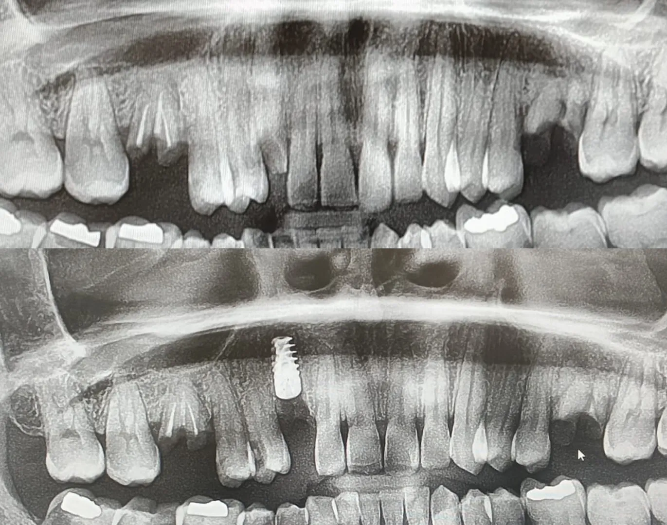 Missing Teeth? Restore Your Smile with Advanced Dental Implants in Anna Nagar, Chennai