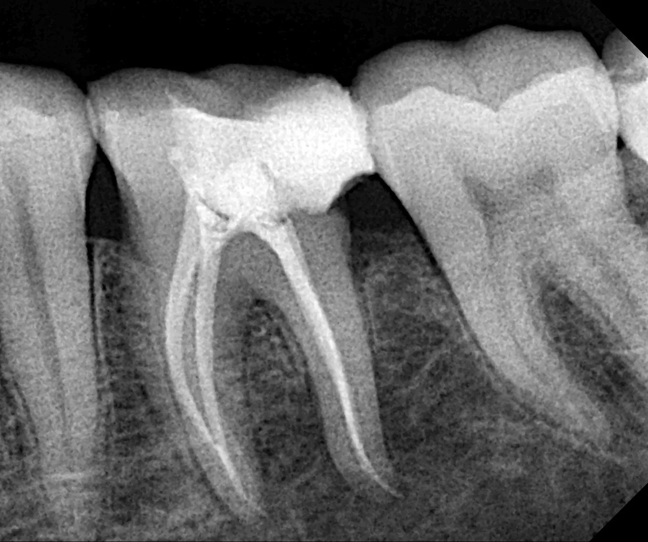 How Long Does Root Canal Treatment Take? Timeline Explained by Dentists in Mulund West Mumbai
