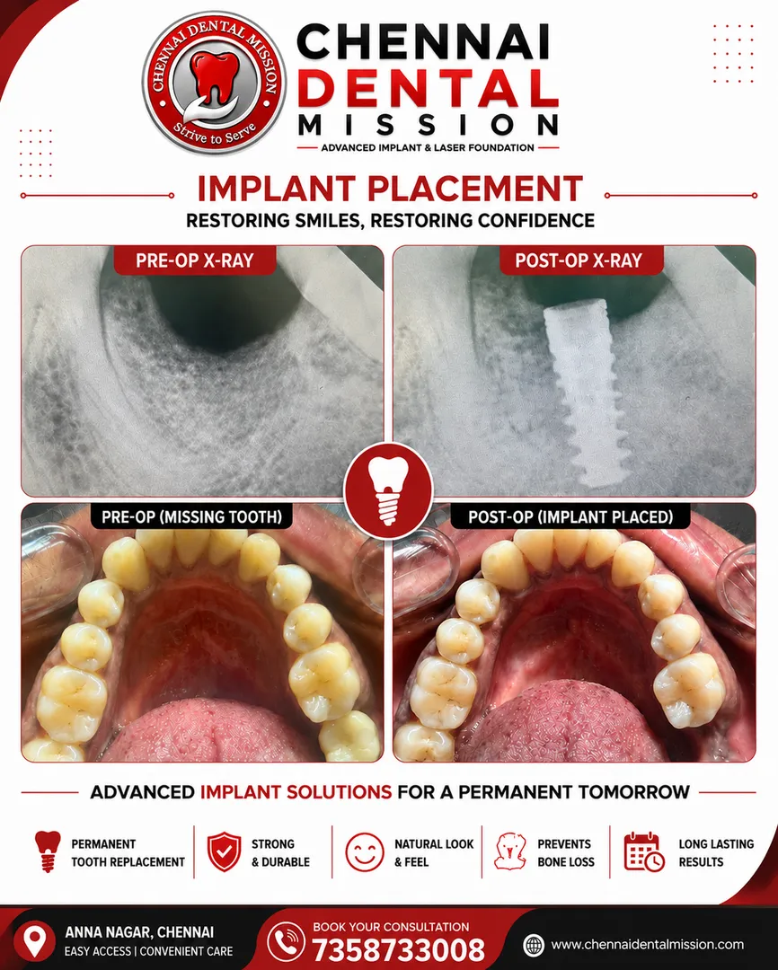 Dental Implants in Anna Nagar, Chennai – Permanent Solution for Missing Teeth