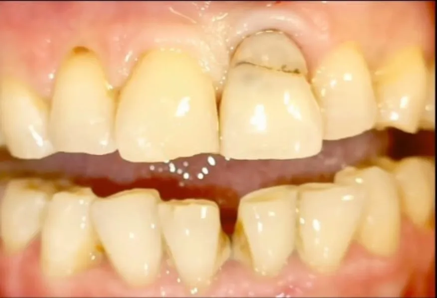 Emergency Dentist in Thane: What to Do During Severe Tooth Pain
