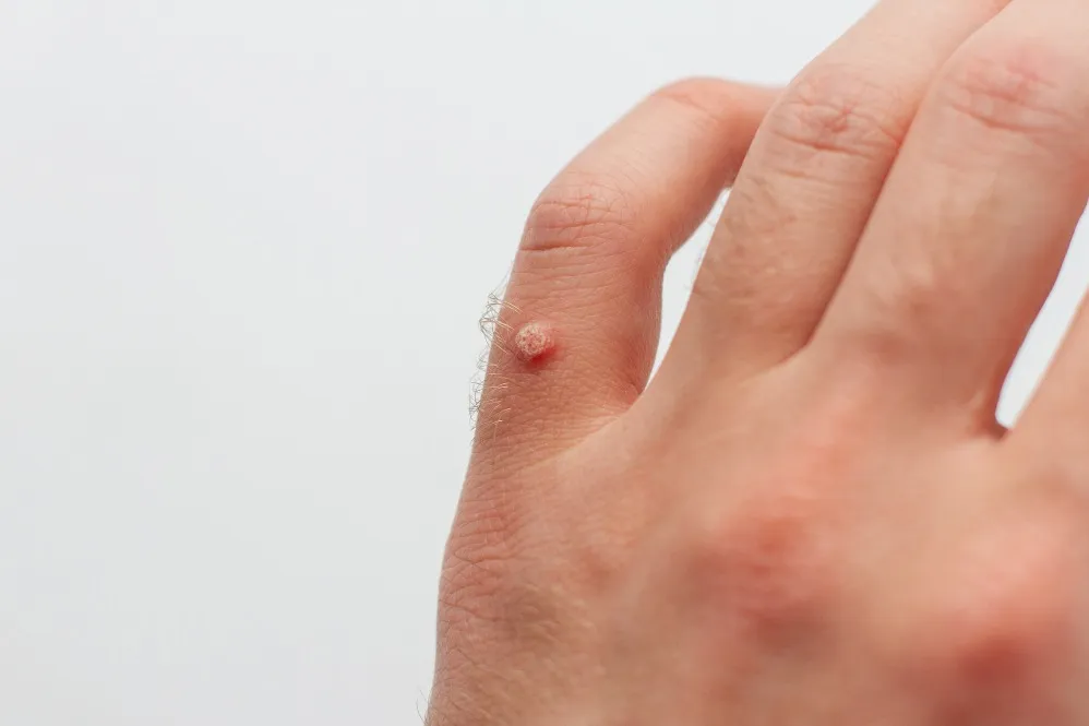 Wart Removal Treatment in Nandini Layout