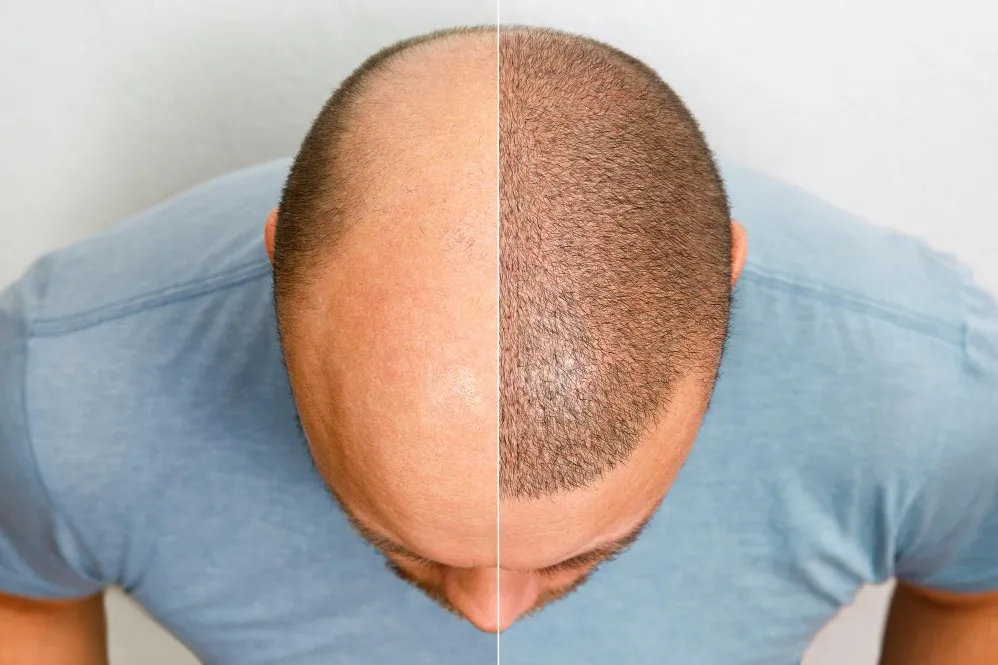 Hair Transplant Cost in Mumbai