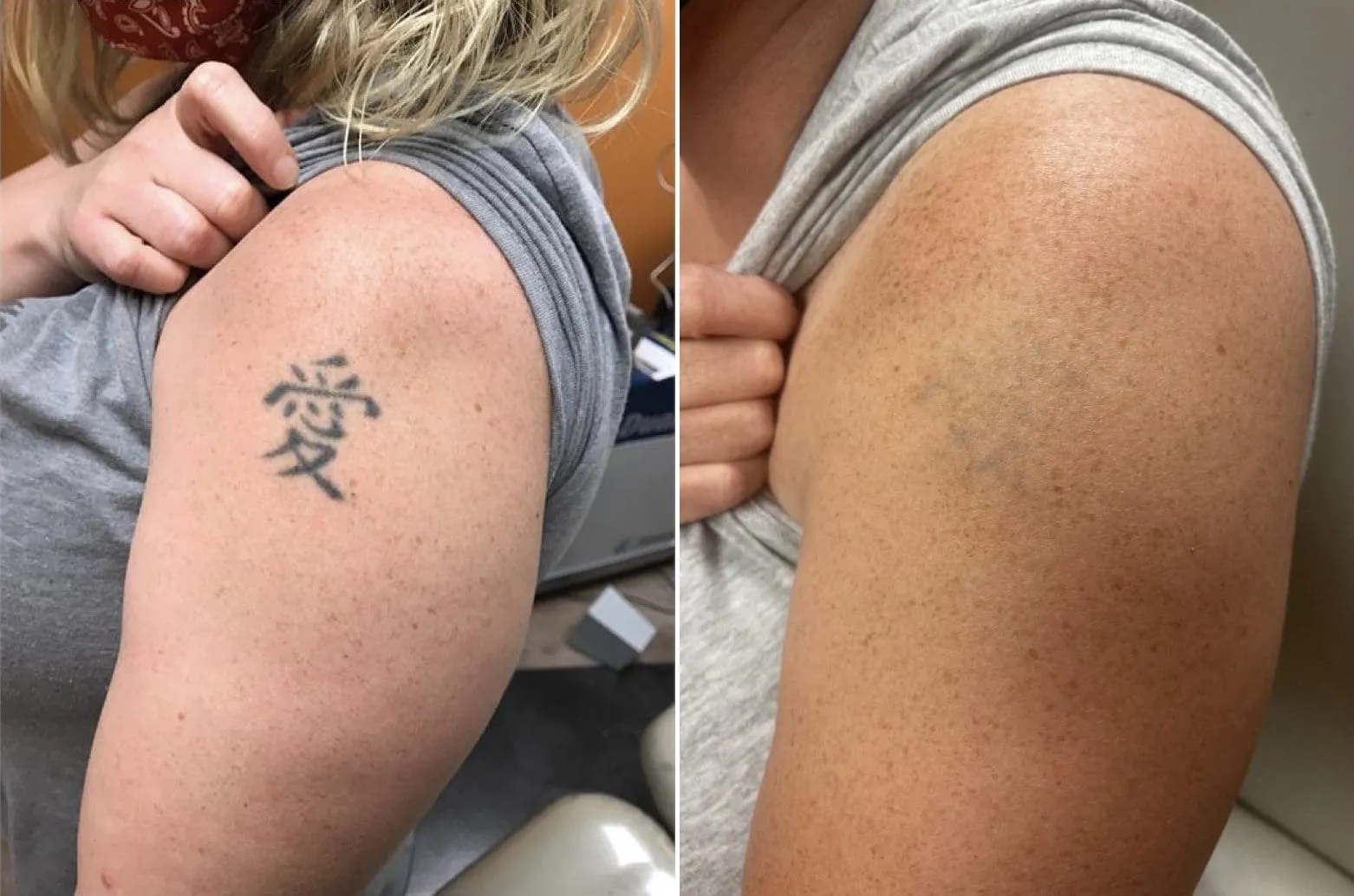 Tattoo removal In Vashi