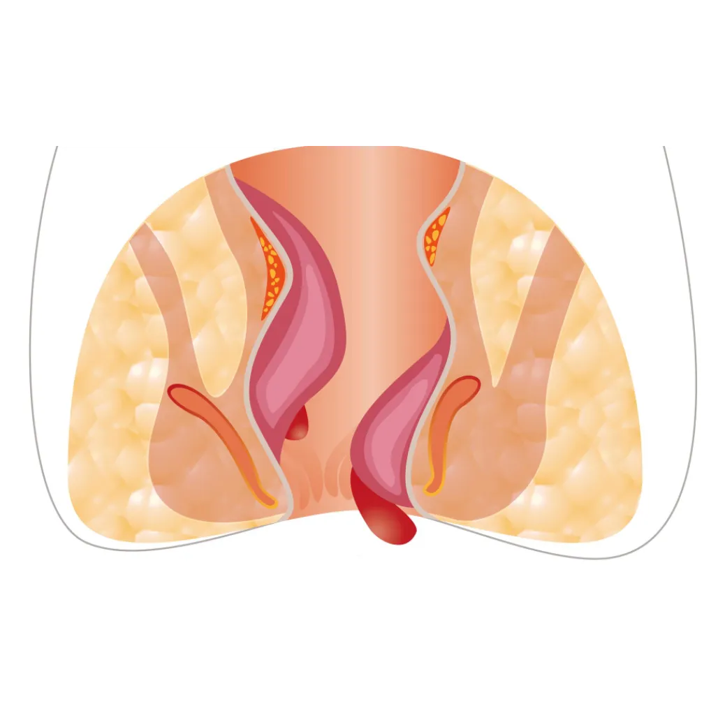Piles Treatment in Thane – Finding Relief from a Common Yet Often Ignored Condition
