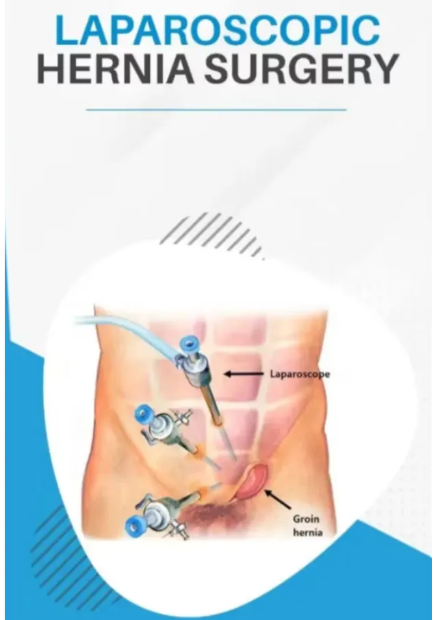 Laparoscopic Hernia Surgery in Dombivli East | A Modern Approach to Hernia Repair