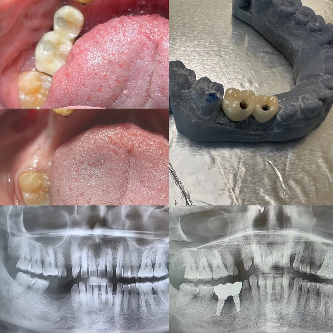 Is a dental implant better than a bridge?