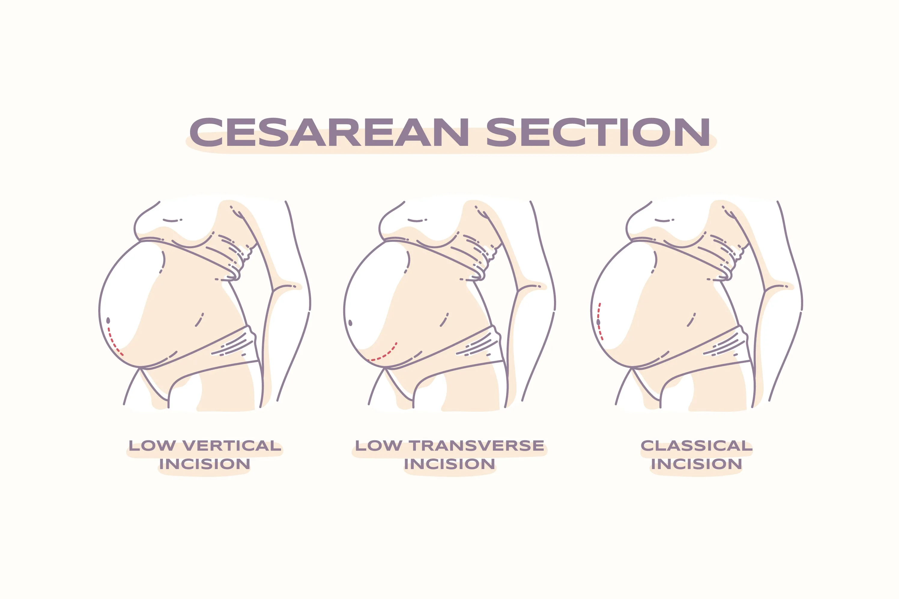 Cesarean Section in Thane - When Surgical Delivery Becomes the Safer Choice