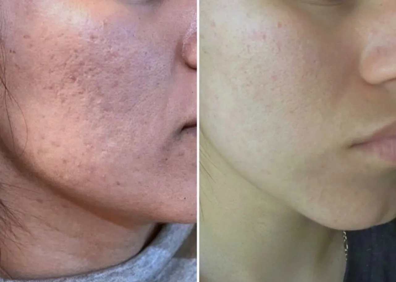 Microneedling for acne scars at Rakesh Reddy's Skin Clinic located at Sanjay Nagar, Bengaluru