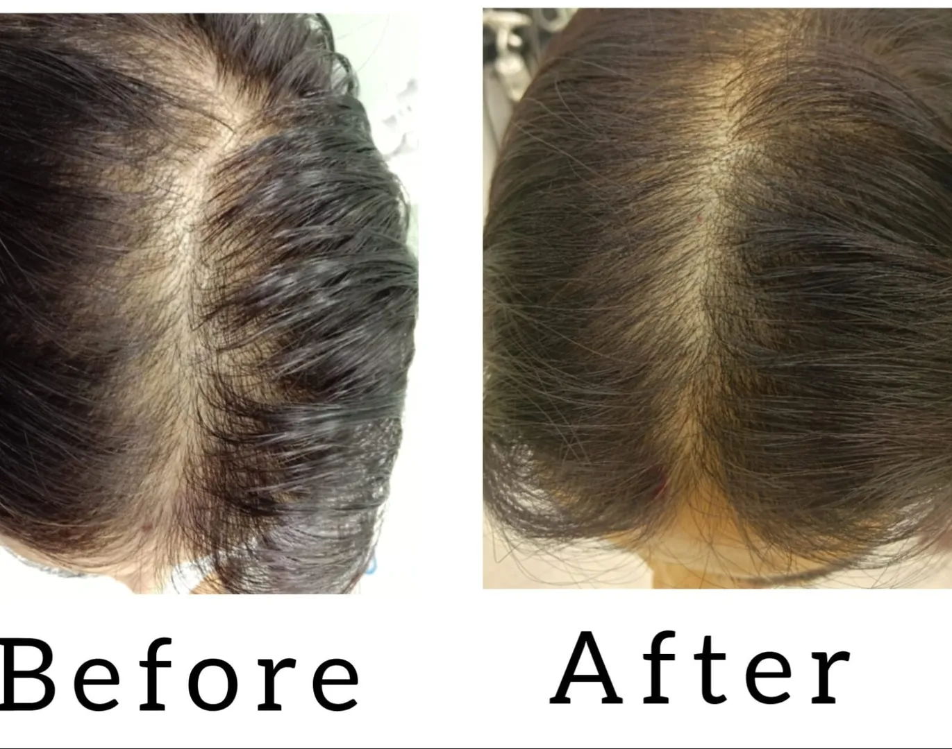 QR 678 Treatment with Dr.Drama Pen Treatment In Vashi