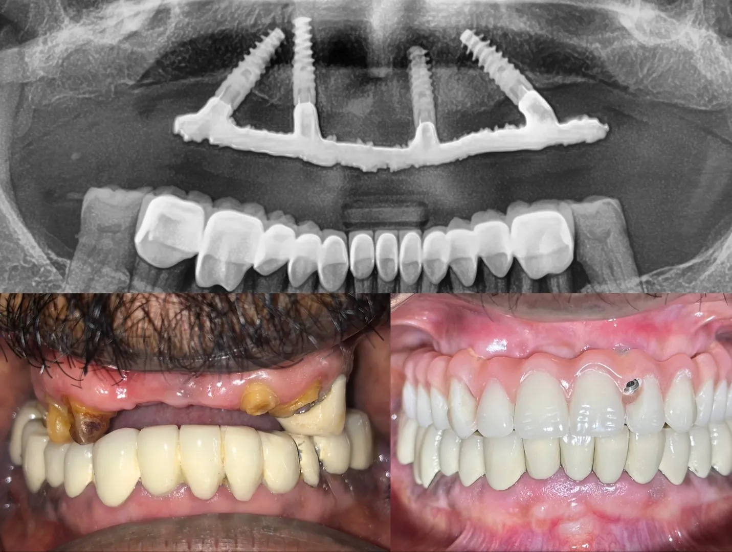 Can I chew normally again after getting a dental implant?