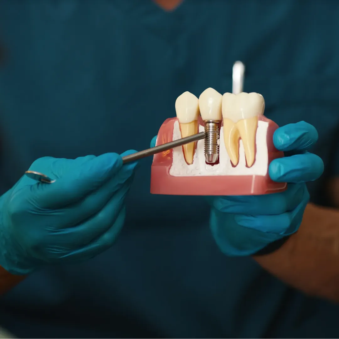 Best Dental Implants in Kothrud