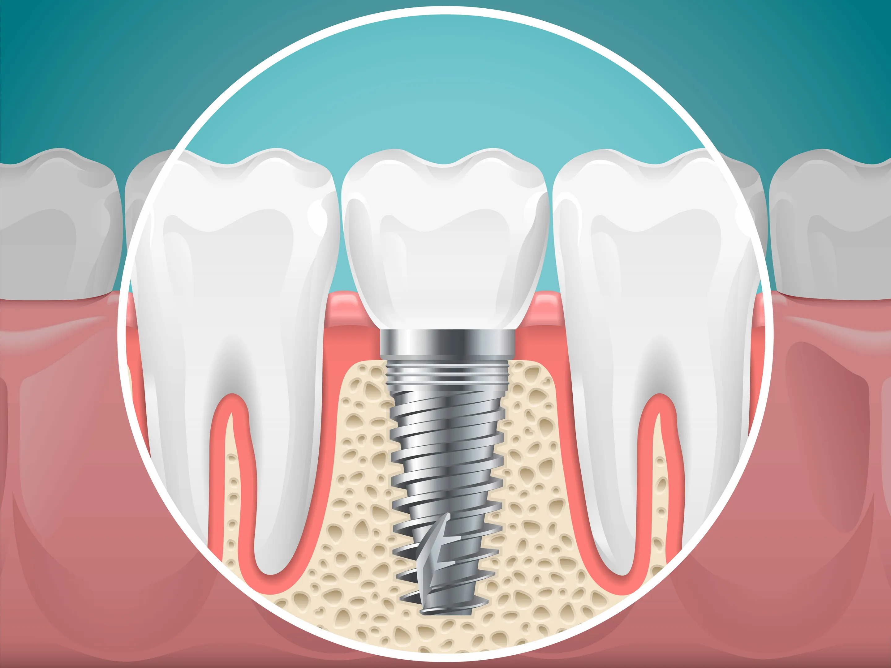 Implant Dentistry Specialist in Bhugaon for Permanent Tooth Replacement