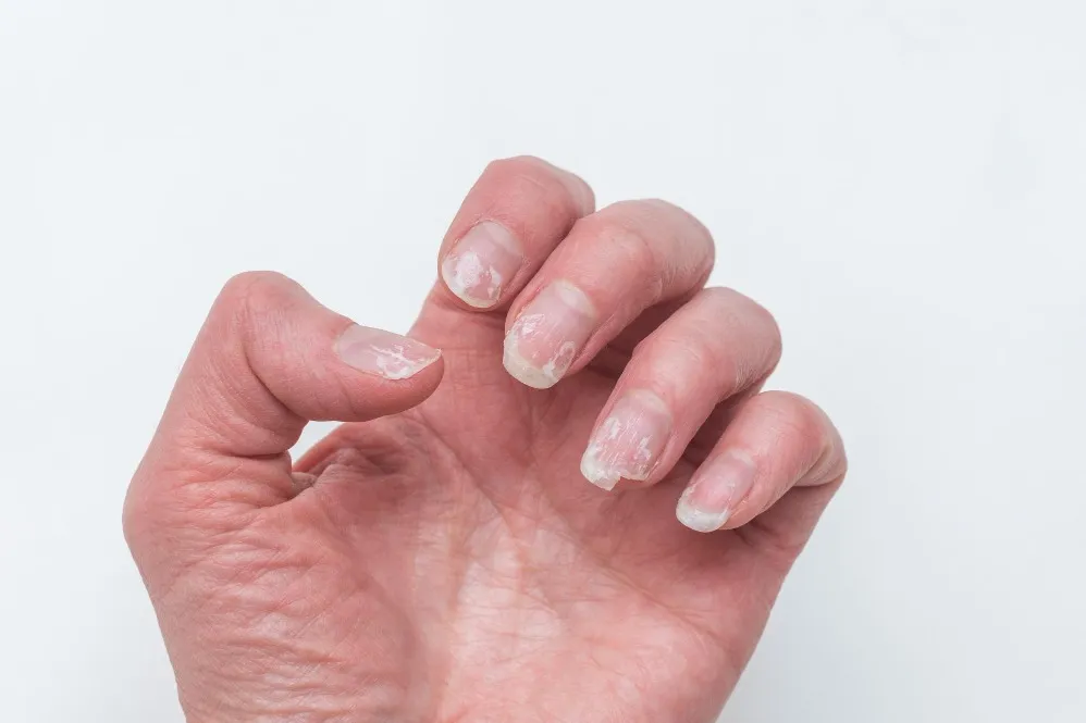 Treatment for Nail Disorder in Kamakshipalya