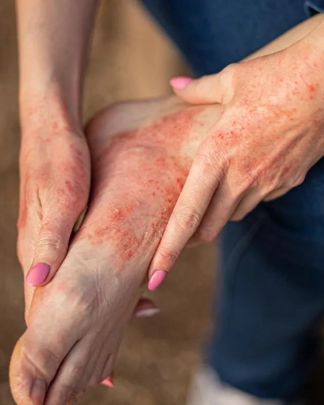 Eczema Care and Treatment in Mahalaxmi Finding Relief from Persistent Skin Irritation