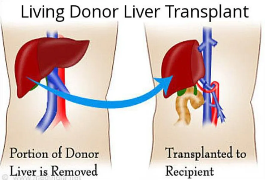 Living Donor Liver Transplant: How It Works, Who Can Donate, and What Patients Should Know
