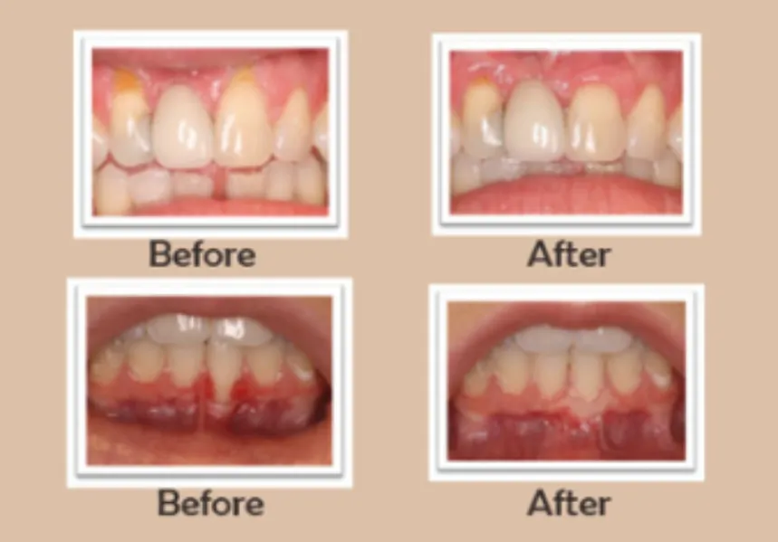 Periodontal Surgery Explained: When Gum Treatment Becomes Necessary