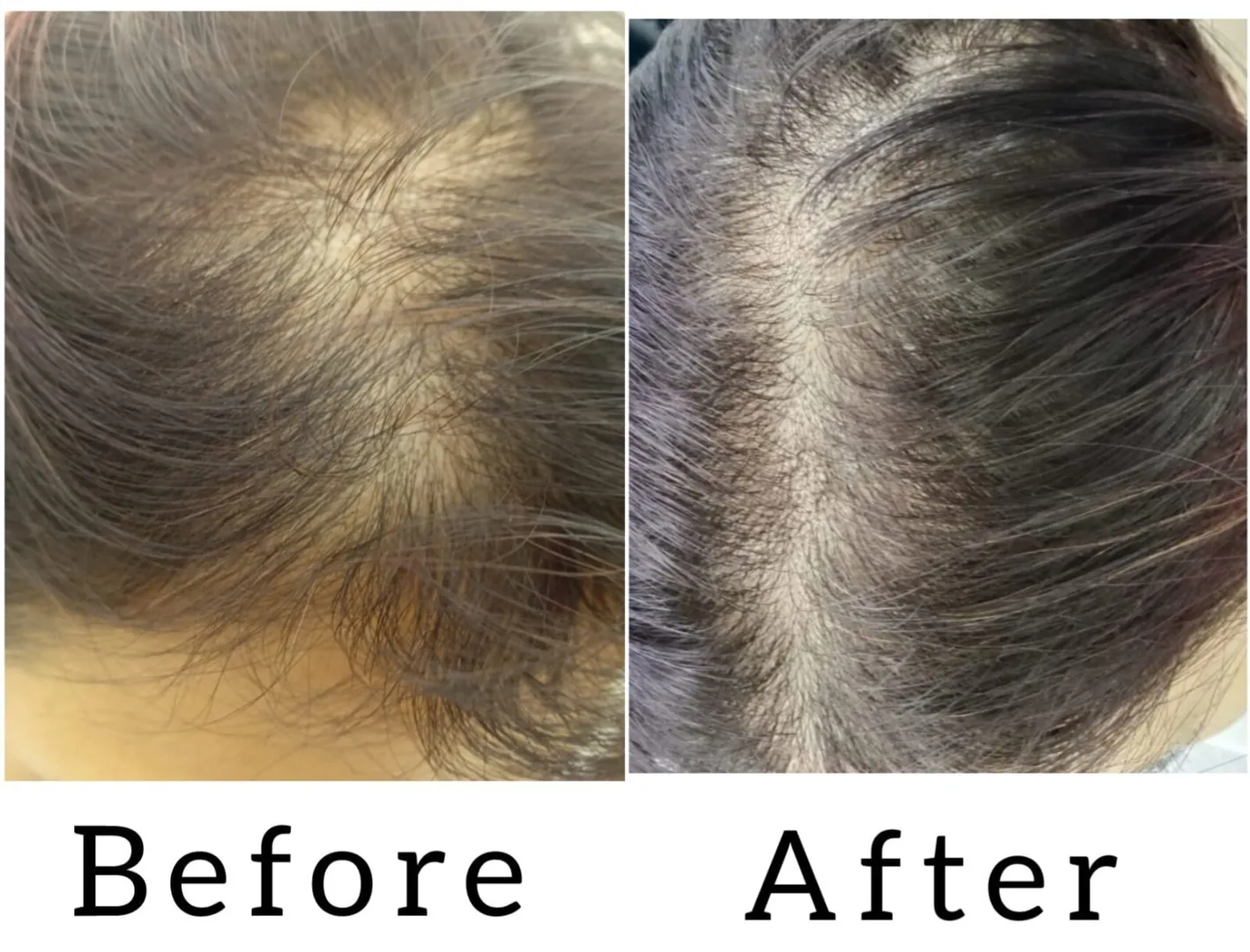 QR 678 Treatment with Dr.Drama Pen Treatment In Vashi