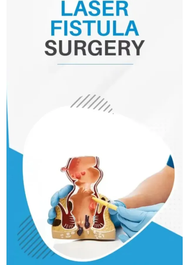 Laser Fistula Surgery in Dombivli East | Advanced Care for Anal Fistula