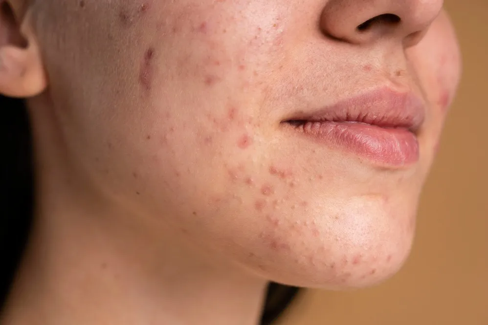 Acne Scar Treatment in Pune – Moving Beyond the Marks Left Behind