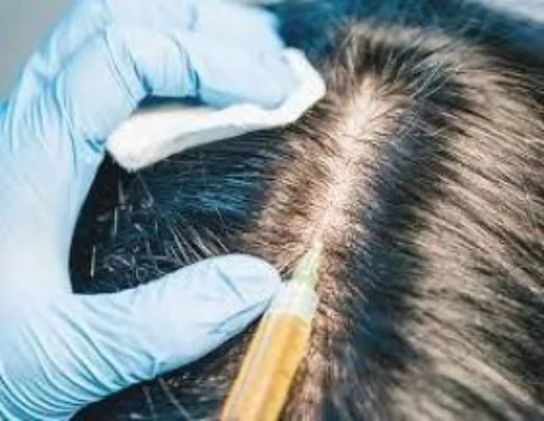 Gindodia Hospital | Hair Follicle Regeneration in Dhule
