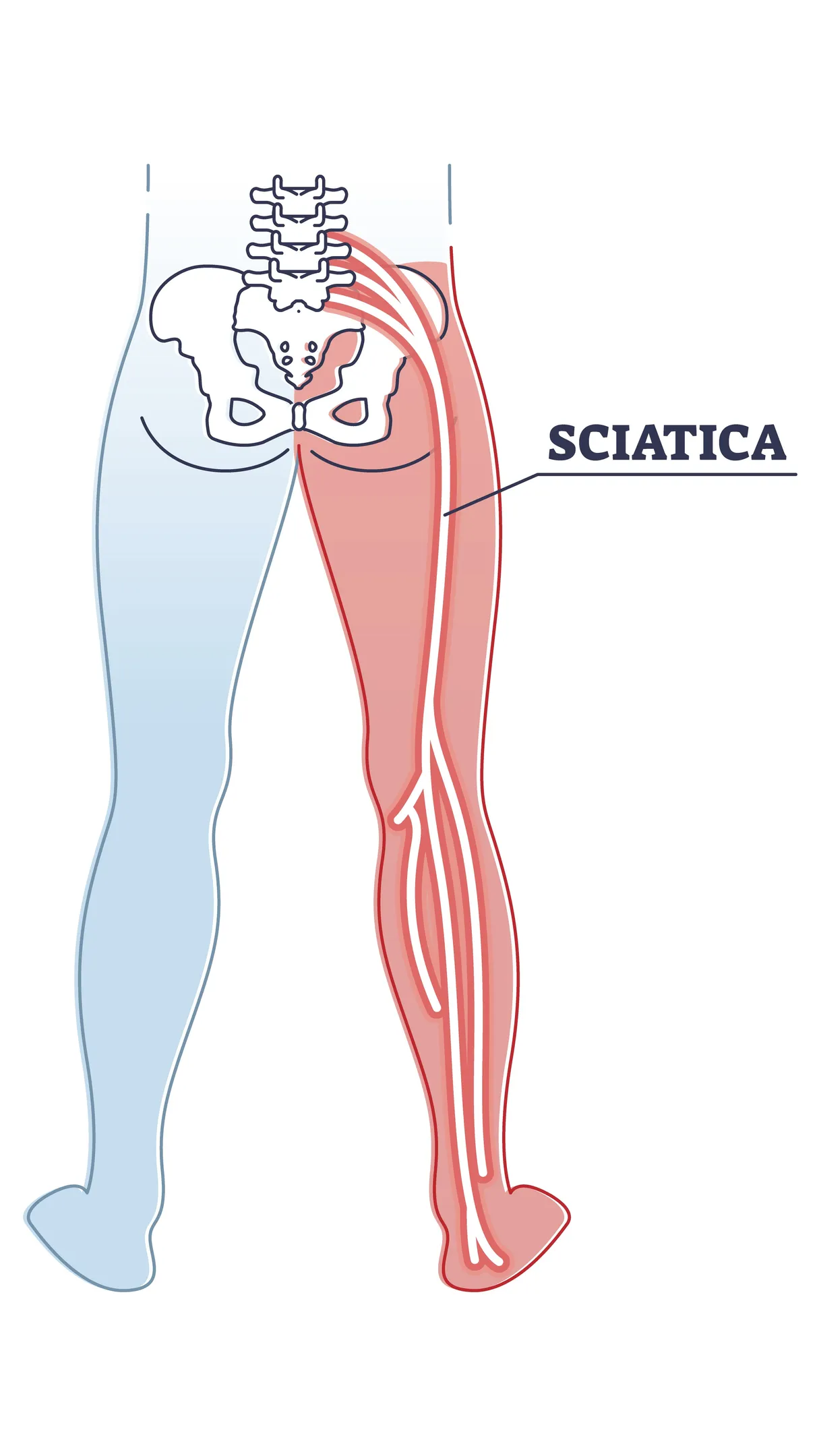 Sciatica Nerve Pain Treatment in Jaipur Understanding Pain That Travels Beyond the Back