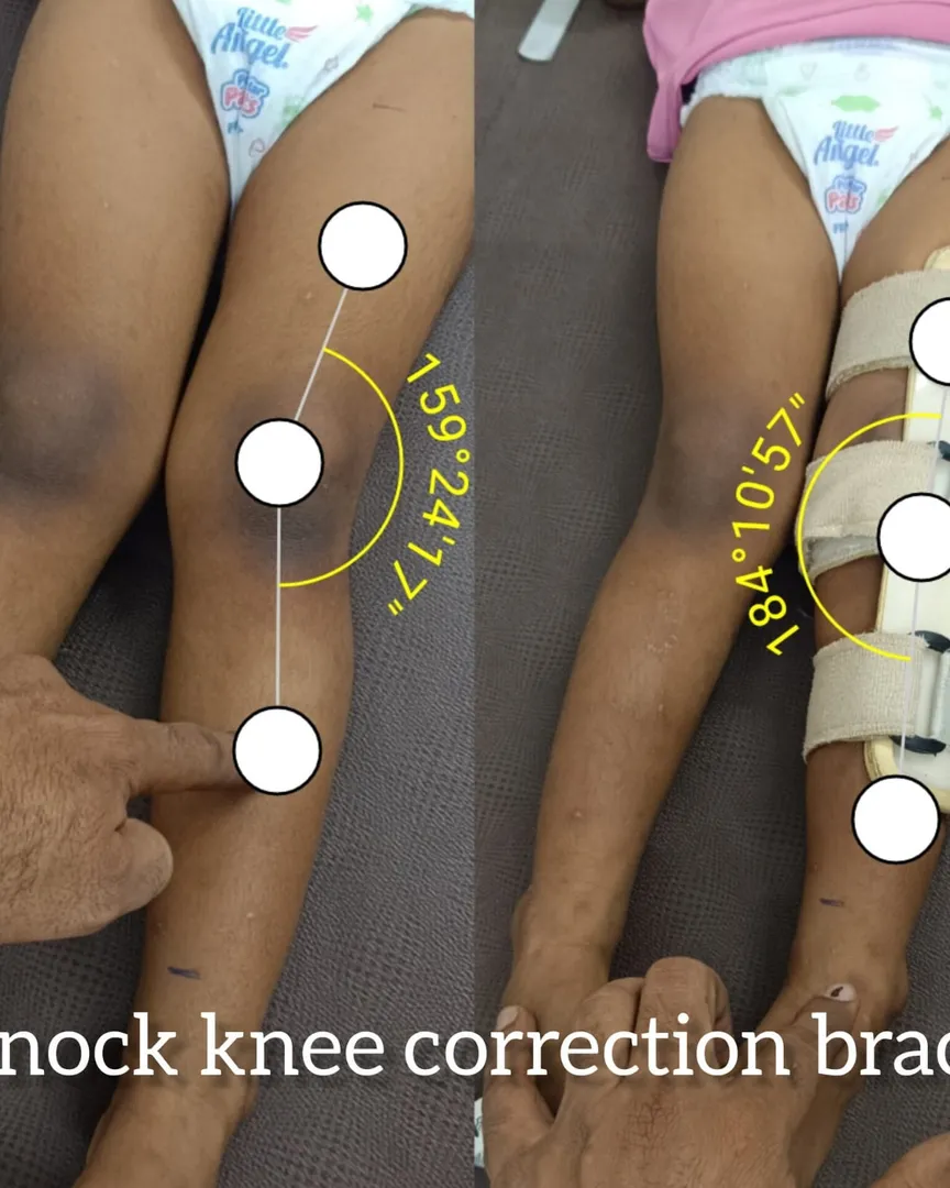 Knock Knee Correction Brace Available In Kalwa West