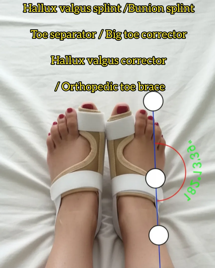 Hallux Valgus Splint / Orthopedic Toe Separator –Available on order In Kalwa West Thane