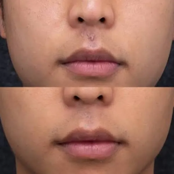 Treatment of Traumatic scars at Rakesh Reddy's skin clinic, Sanjay Nagar, Bengaluru with Microneedli