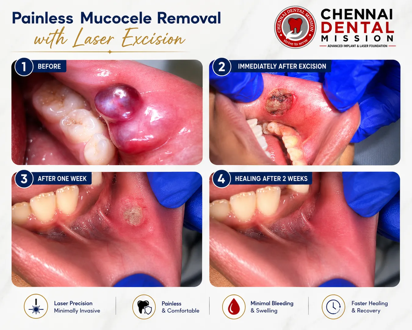 Painless Dental Treatment