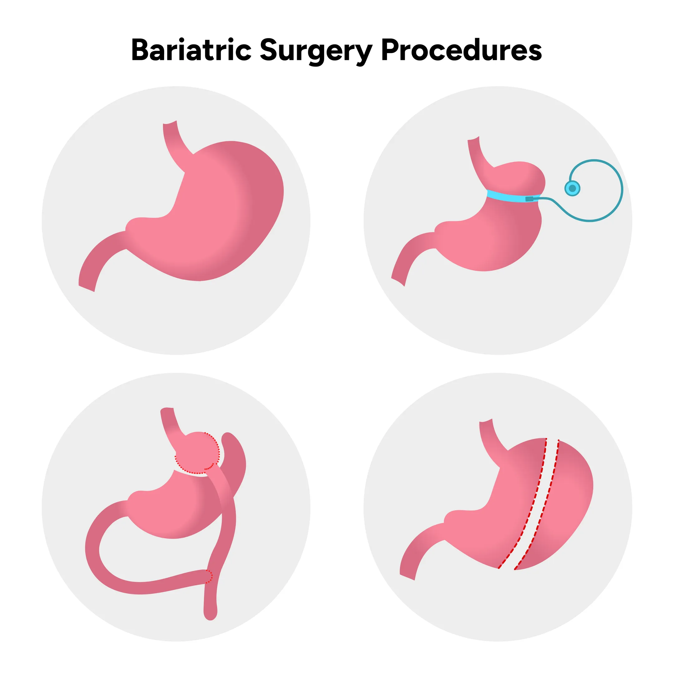 Bariatric Surgery in Dombivli East | A Step Toward Better Health