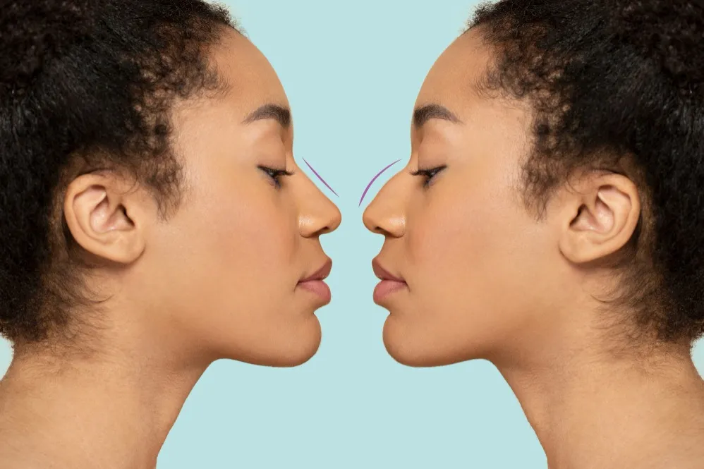 Rhinoplasty Surgery in Camp Pune for Nose Reshaping and Facial Balance