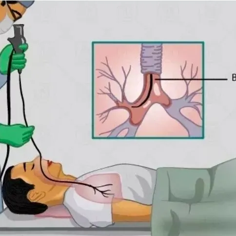 pulmonologist and broncoscopy, Vidhyadharnagar jaipur