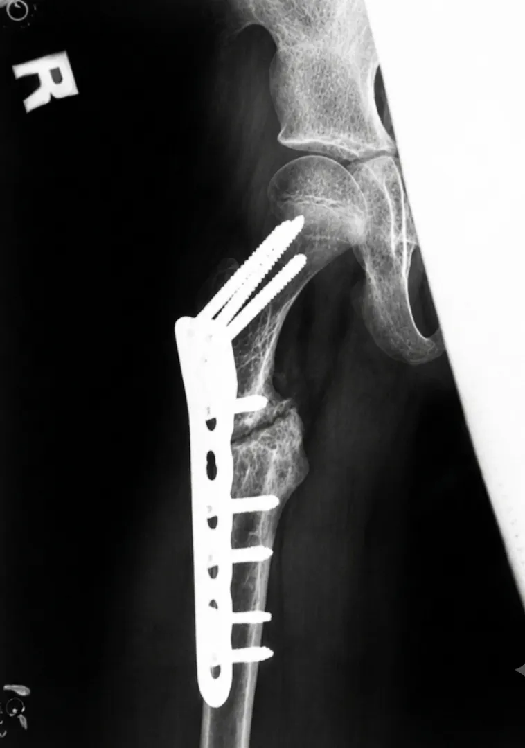 Megaprosthesis Treatment in Mumbai Advanced Reconstruction After Bone Tumor Surgery