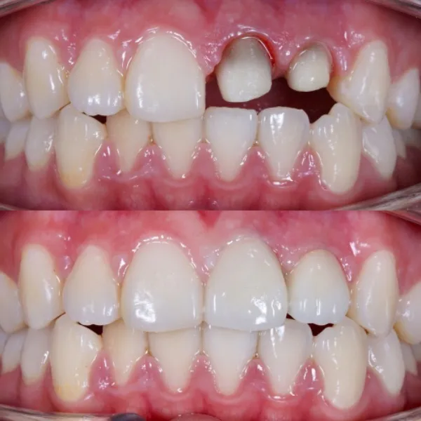 Crowns Treatment In Vashi