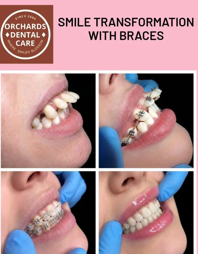 Orthodontics @ Bangalore
Warning : this transformation may cause extreme smiling š