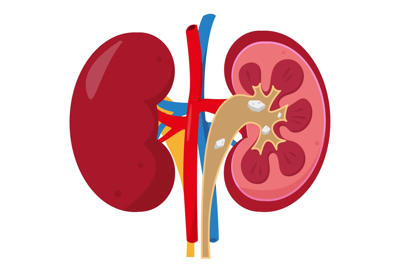 Kidney Stone Removal in Thane West