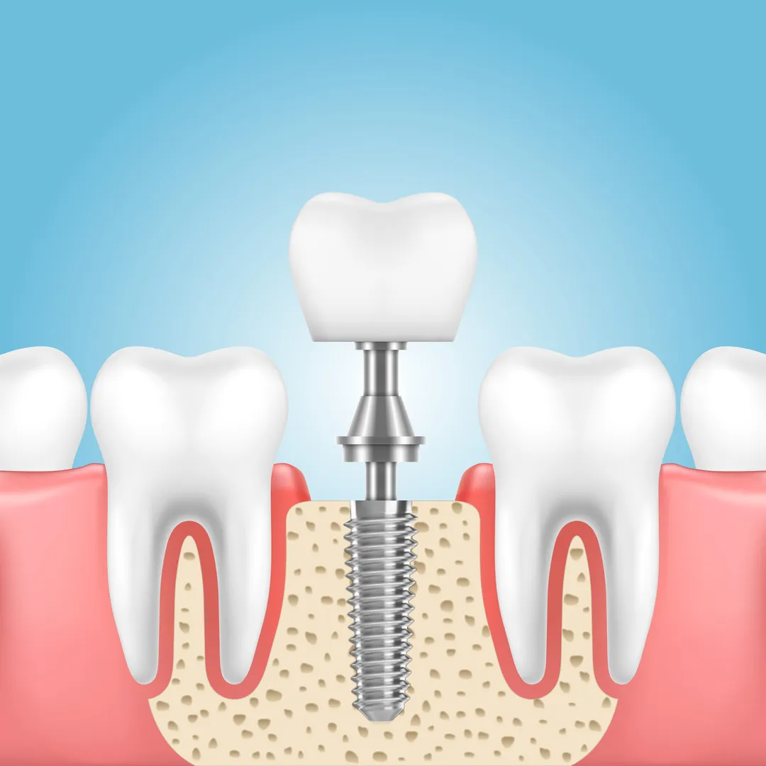Dental Implant Specialist in Diva Thane for Advanced Tooth Restoration
