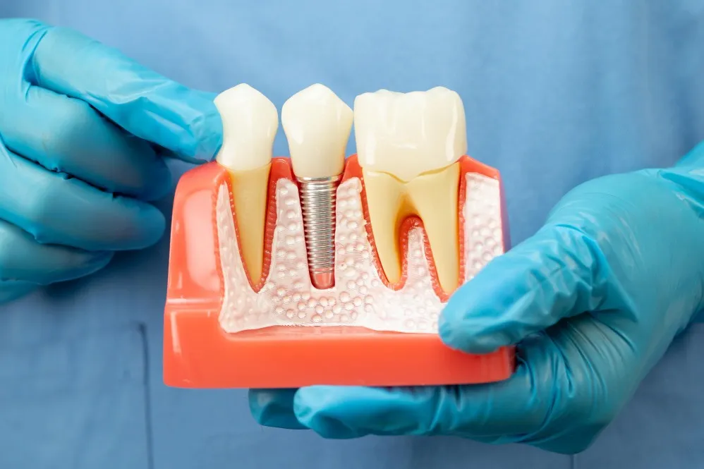 Corticobasal Dental Implants: When Are They Recommended and Who Can Benefit?
