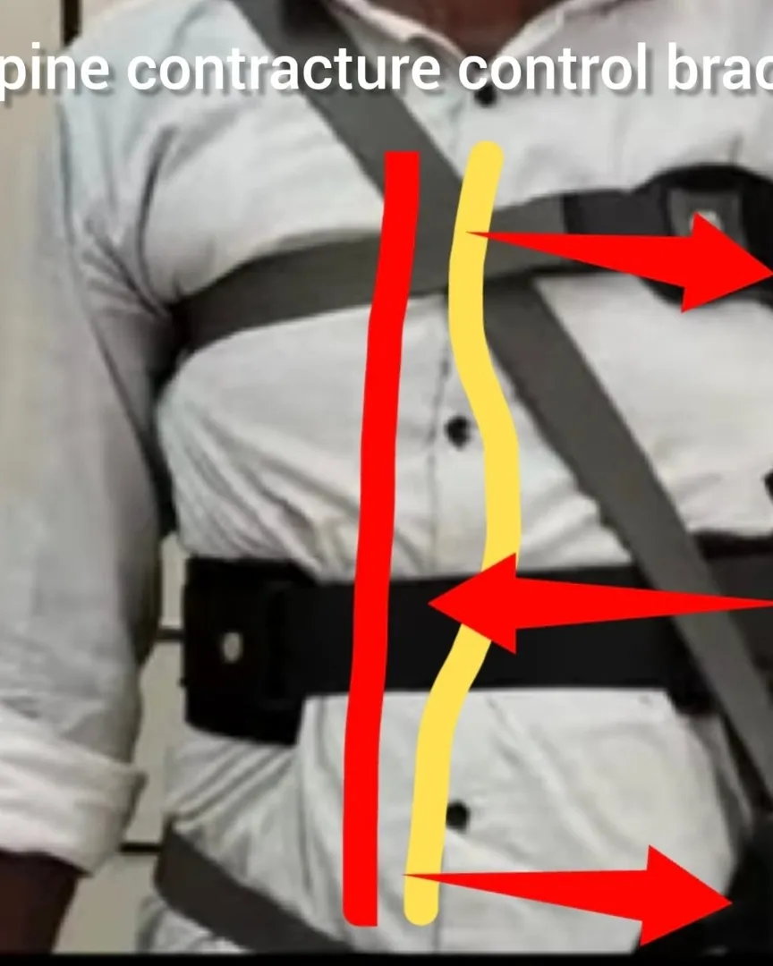 Scoliosis Control Brace Spine Support Correction Belt Available in Kalwa West Thane