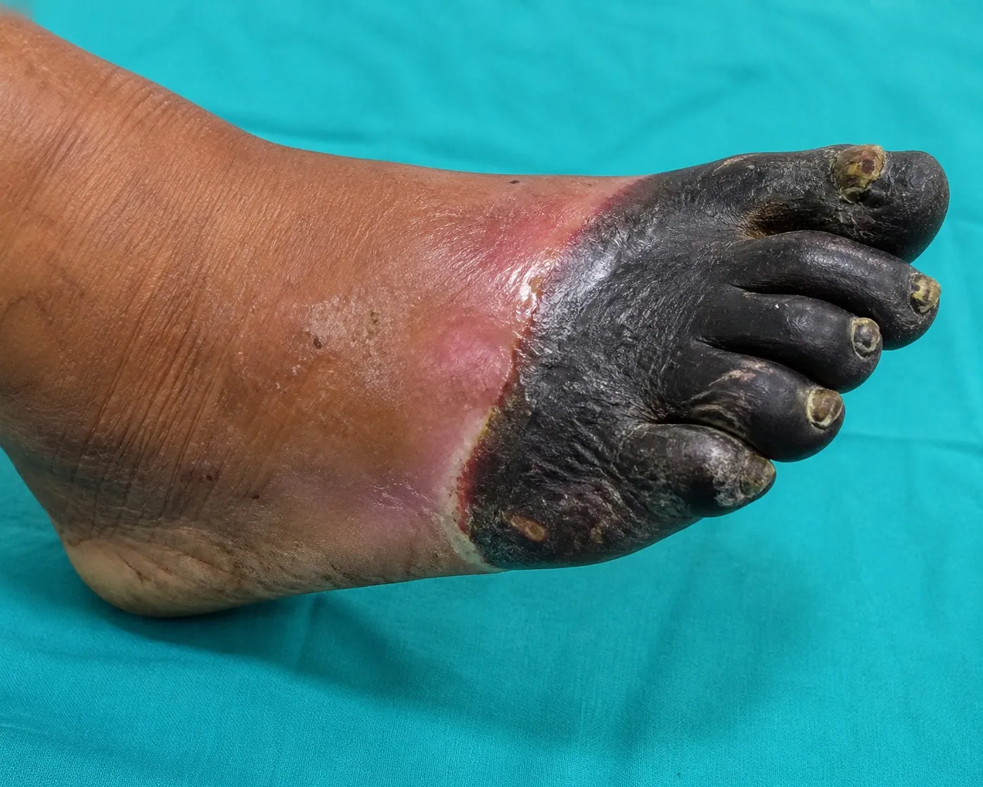 Gangrene Treatment in Mumbai Central – Understanding the Importance of Timely Medical Care