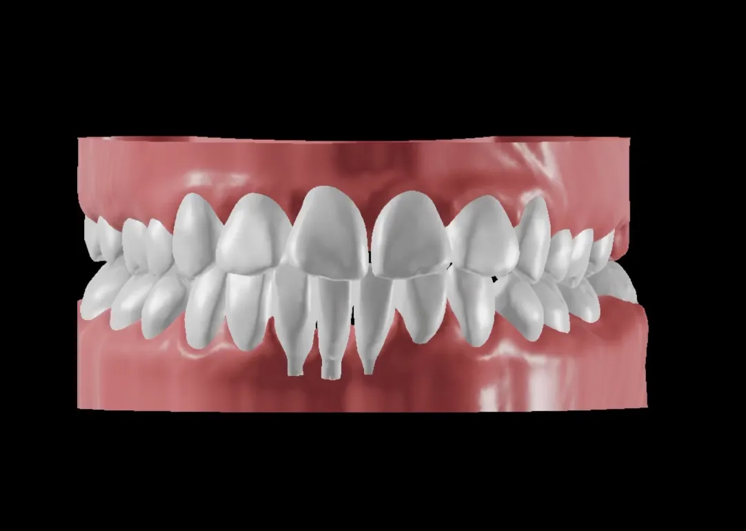 My teeth became crooked again after braces. Can clear aligners fix it?