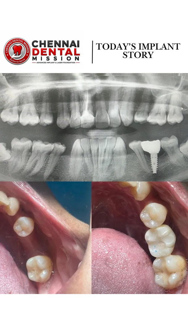 I lost my tooth years ago. Is it too late for a dental implant?