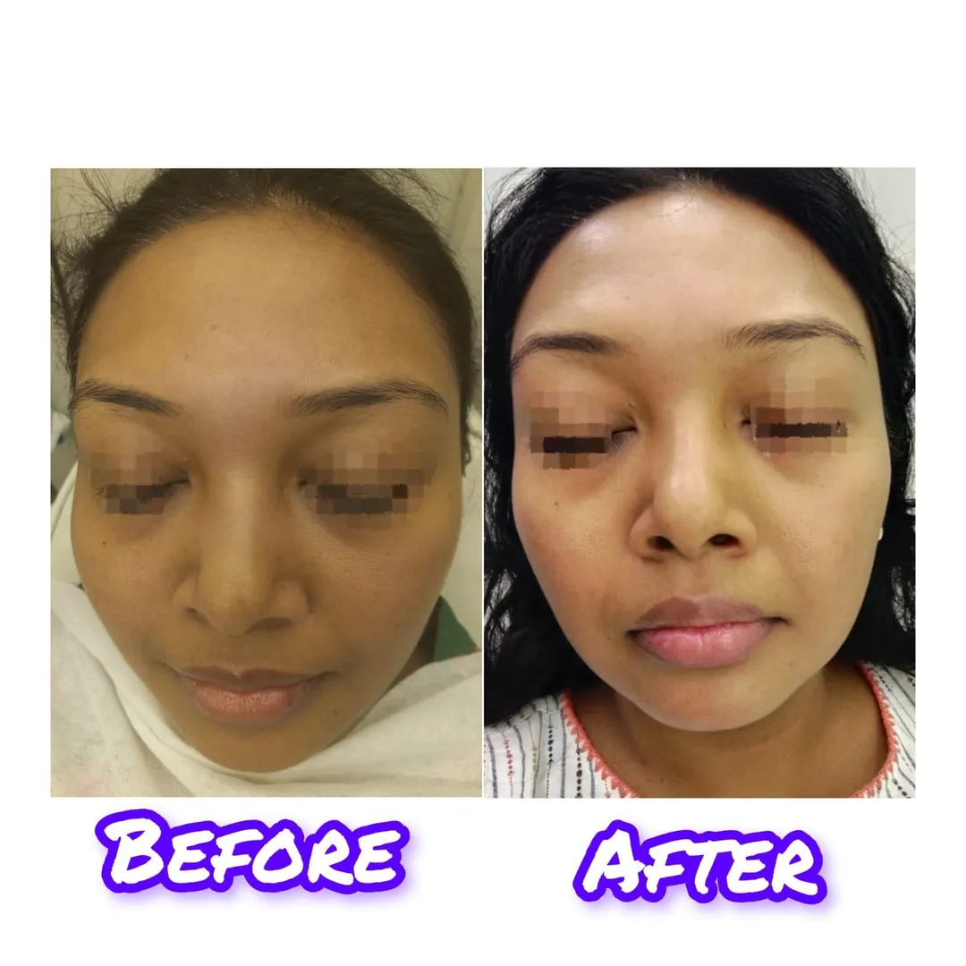 Best Derma Pen Treatment in Vashi
