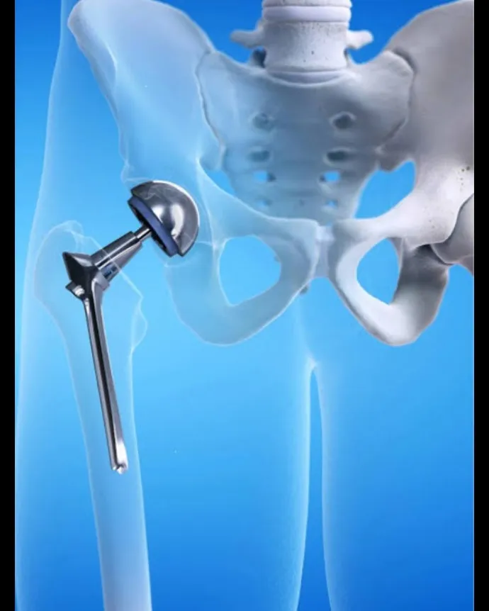 Hip Replacement Surgery in Delhi NCR | Dr. Aman Dua