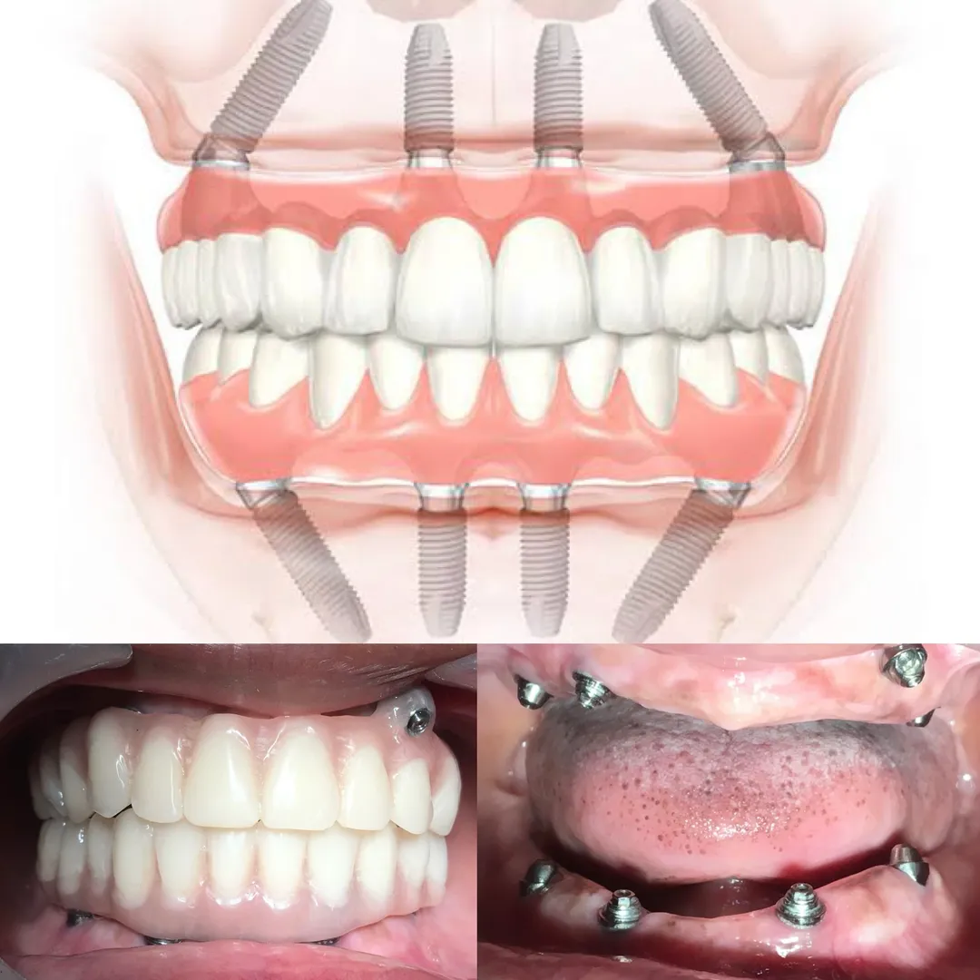 Will my dental implant look like a natural tooth?