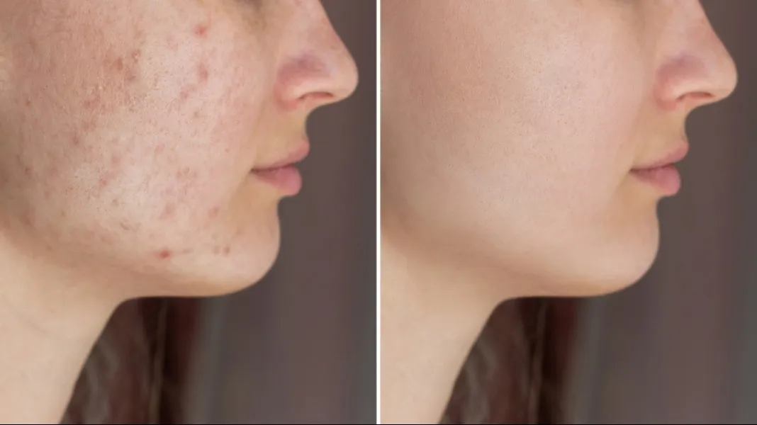 Acne Treatment Solutions in Marine Lines Managing Breakouts with Expert Care