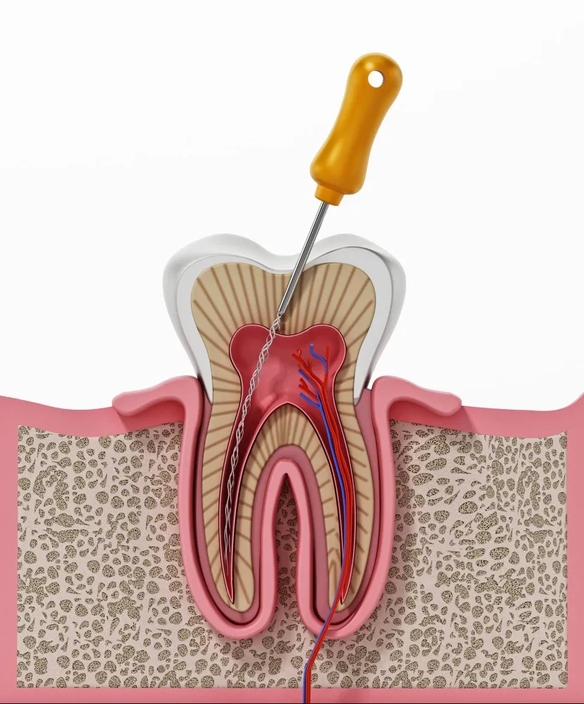 Root Canal Treatment vs Tooth Extraction: Which Is the Better Option for Saving Your Smile?
