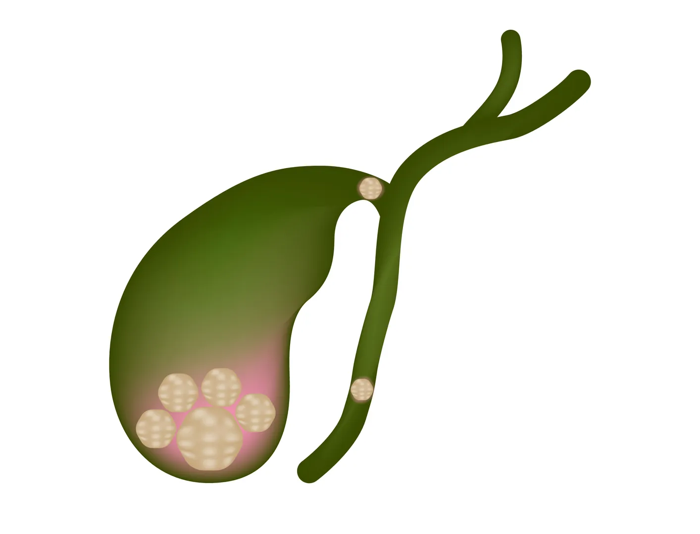 Gallbladder Stone Treatment Specialist in PCMC: When Are Gallstones a Cause for Concern?
