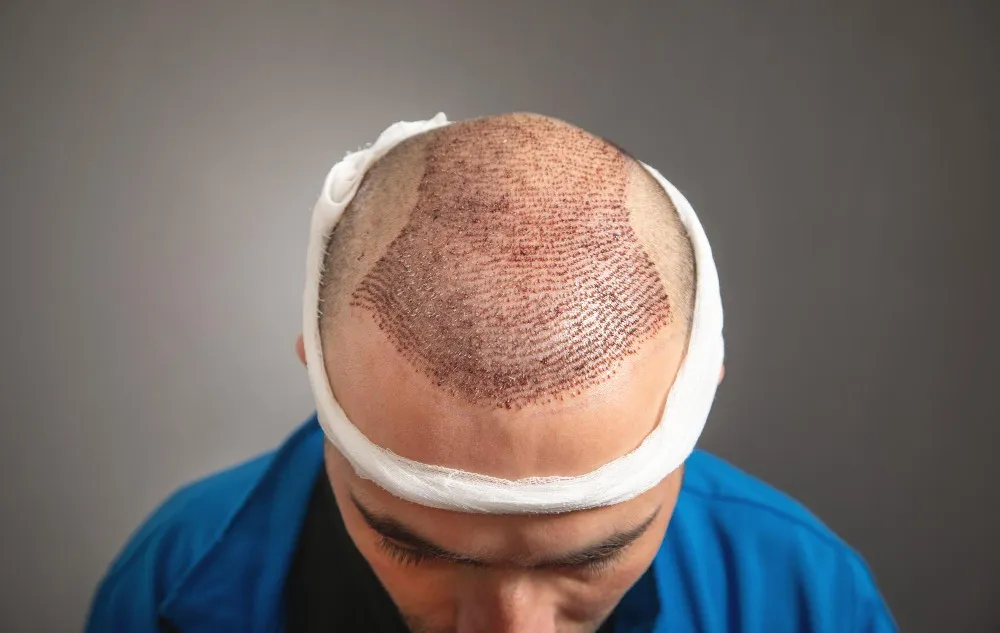 Hair Transplant Surgery in Pune – Restoring More Than Just Hair