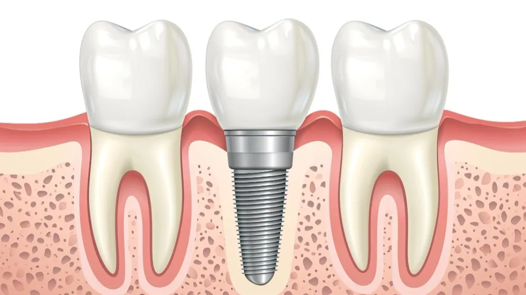 Immediate Loading Dental Implants: How Soon Can You Smile After Tooth Replacement?